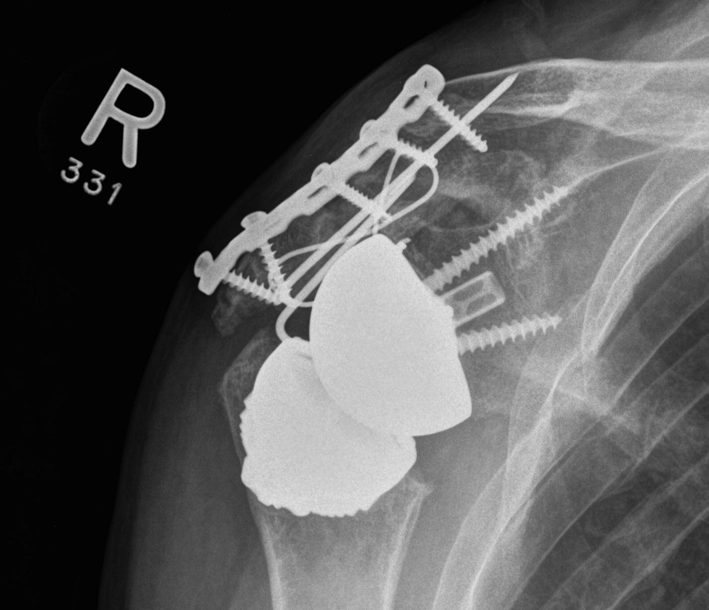 Reverse TSR Acromial Fracture ORIF